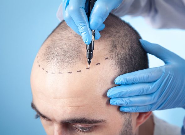 HairScience_Hair-transplant-preparation